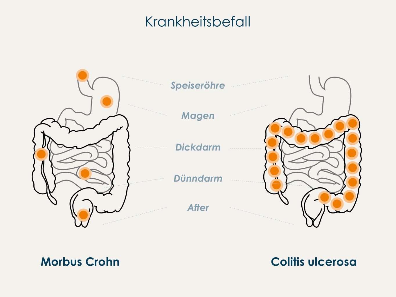 Pflege bei Morbus Crohn und Colitis ulcerosa Korian