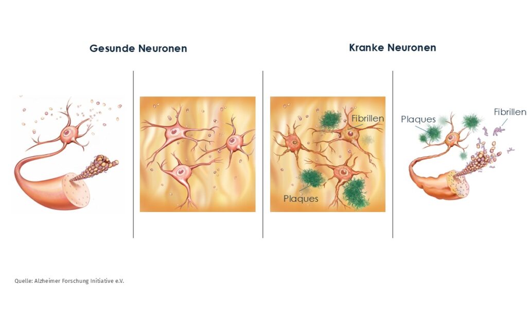 Alzheimer_de_Neuronen_Plaques_Fibrillen