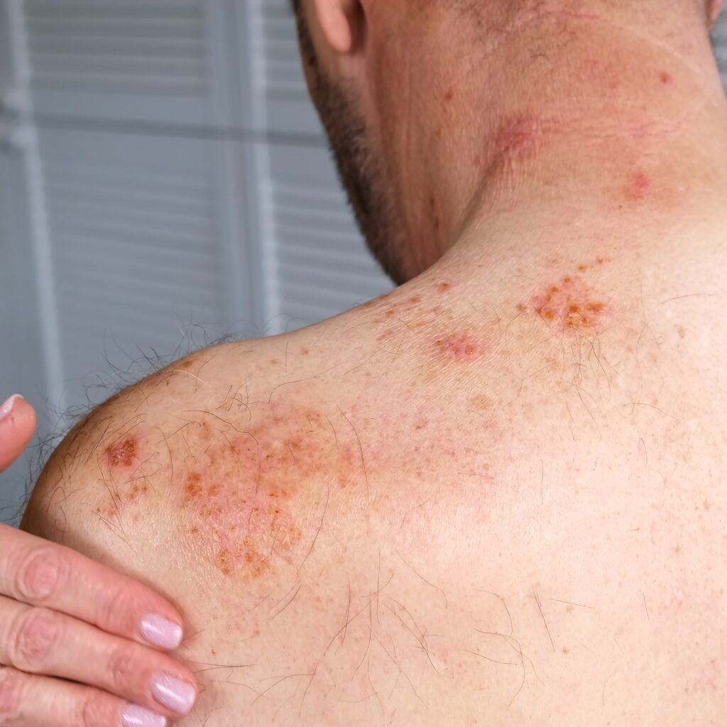 Pflege bei Gürtelrose: Phasen, Verlauf und wichtige Maßnahmen im Pflegealltag